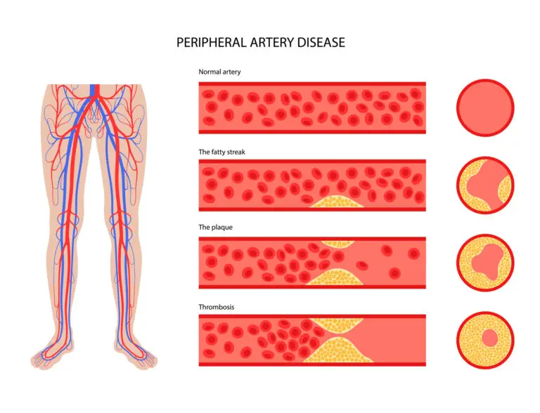 Peripheral artery disease PAD