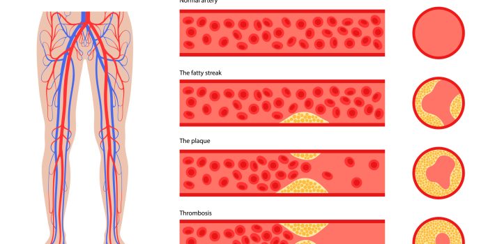 Peripheral artery disease. Ischemia in leg. Cholesterol in human blood vessel. PAD concept. Fat cells in vein artery. Blocked vascular in man body. Medical poster for clinic flat vector illustration